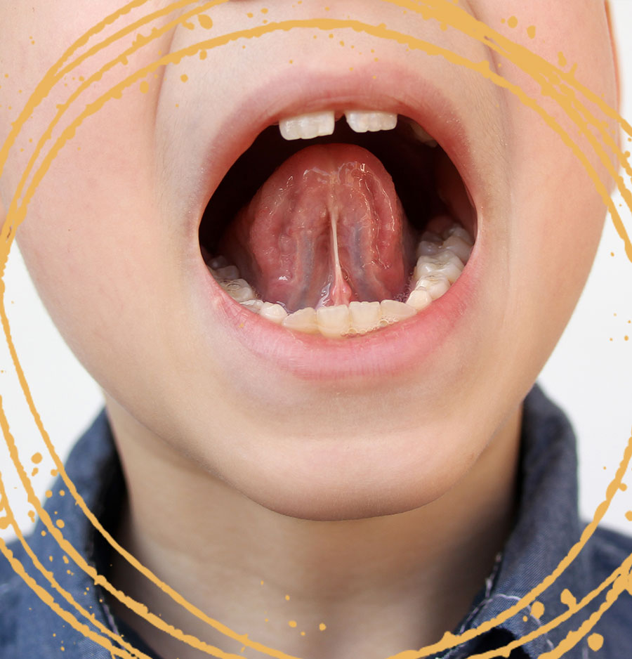Ankyloglossia Ankyloglossia
